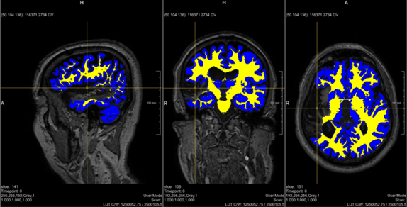 Brain Imaging
